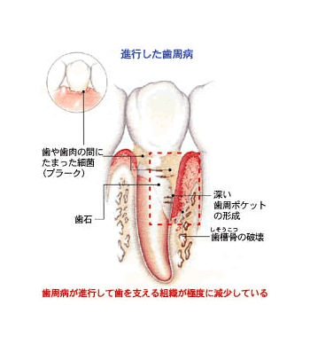 歯周病が進行すると・・・