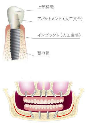 茨城,インプラント